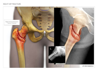 Right Hip Fracture