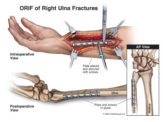 ORIF of Right Ulna Fractures