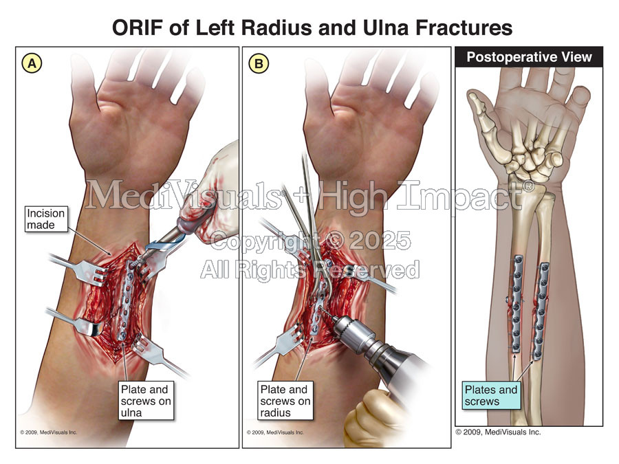 ORIF of Left Radius and Ulna Fractures