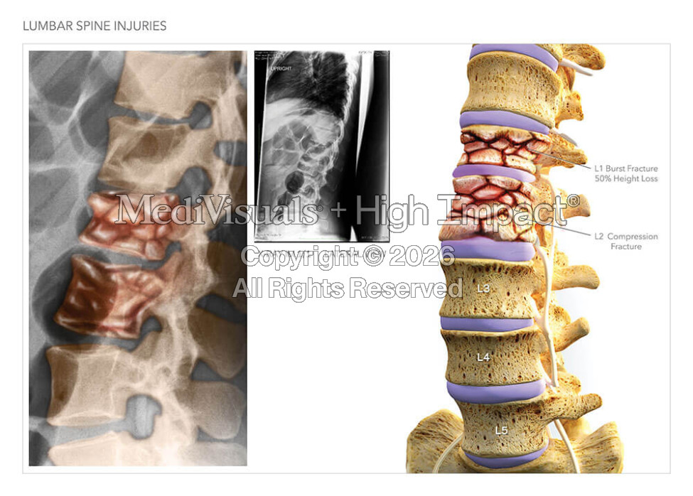 Lumbar Spine Injuries