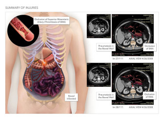 Summary of Bowel Injuries