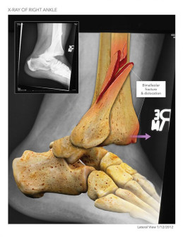 Right Ankle Fracture