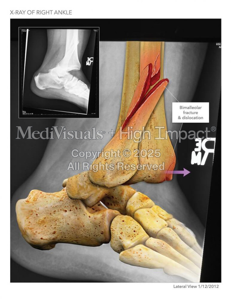 Right Ankle Fracture