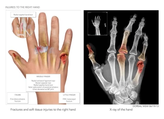 Summary of Hand Injuries and Procedures
