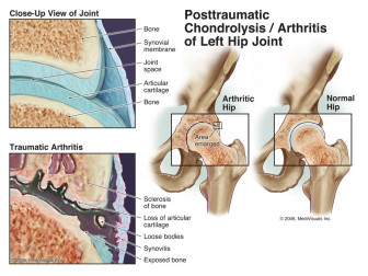 Posttraumatic Chondrolysis / Arthritis of Left Hip Joint