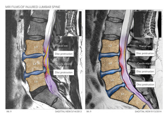 Injured Lumbar Spine