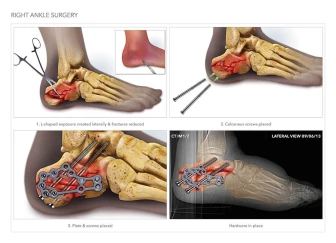 Internal Fixation of Calcaneus Fractures