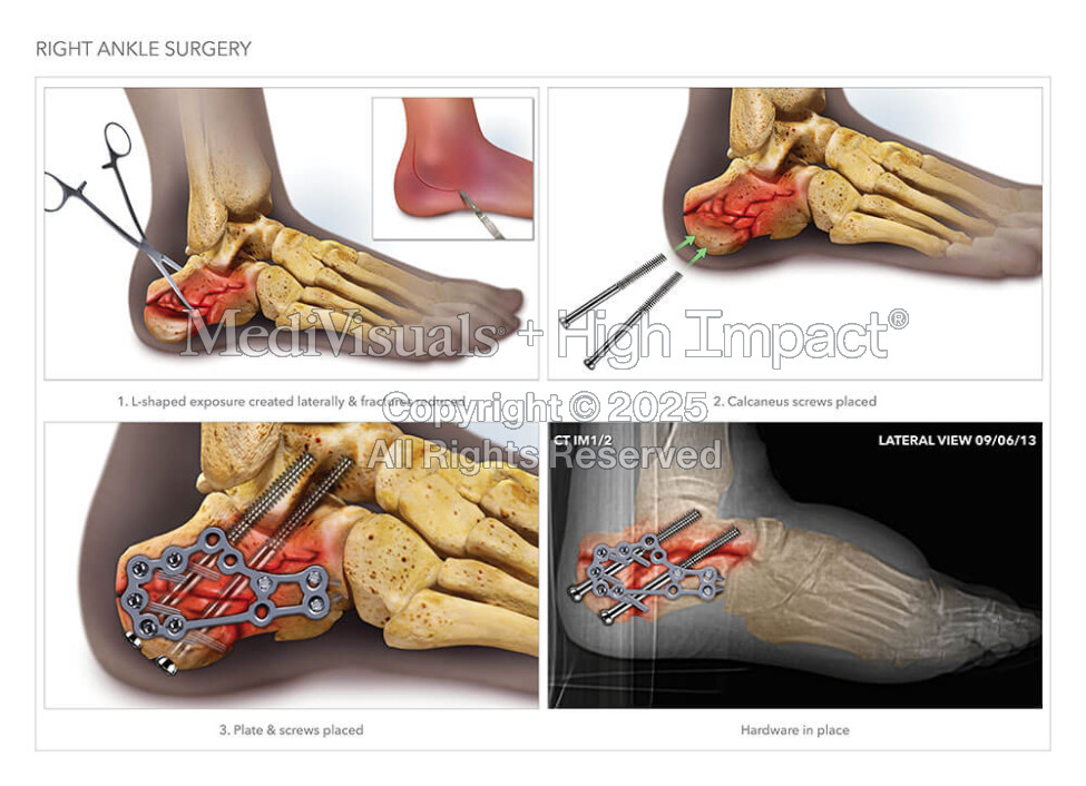 Internal Fixation of Calcaneus Fractures