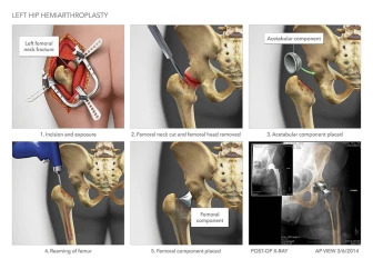 Left Hip Hemiarthroplasty