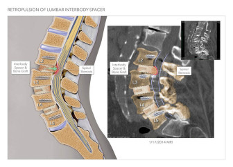 Retropulsion of Lumbar Interbody Spacer