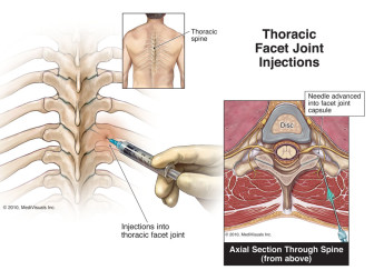 Thoracic Facet Joint Injections