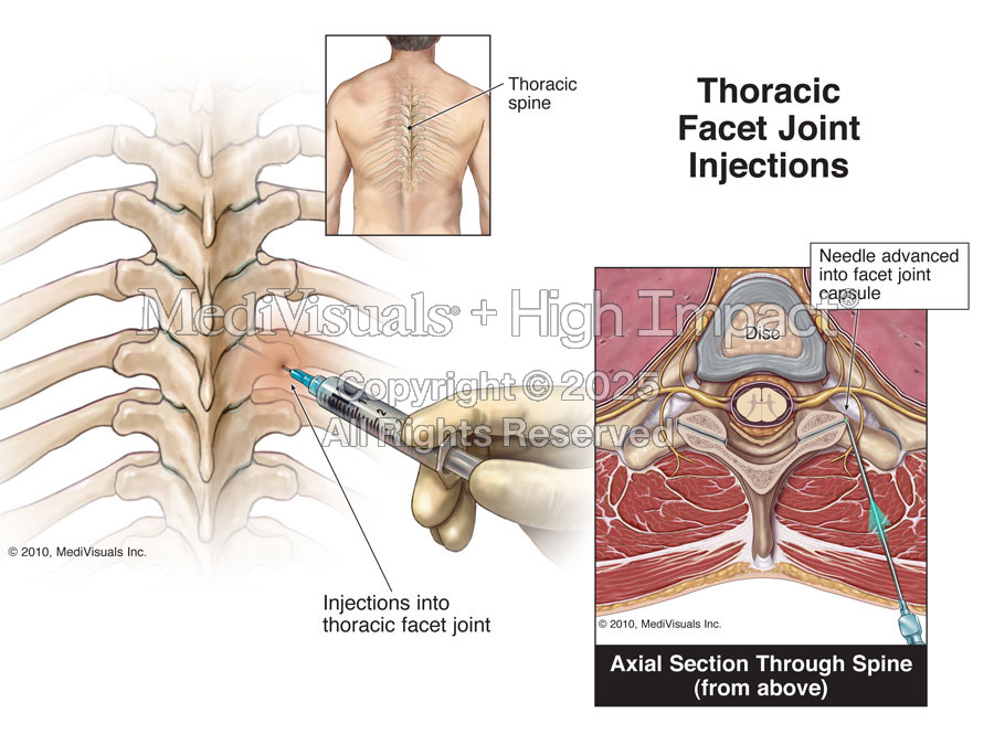 Thoracic Facet Joint Injections
