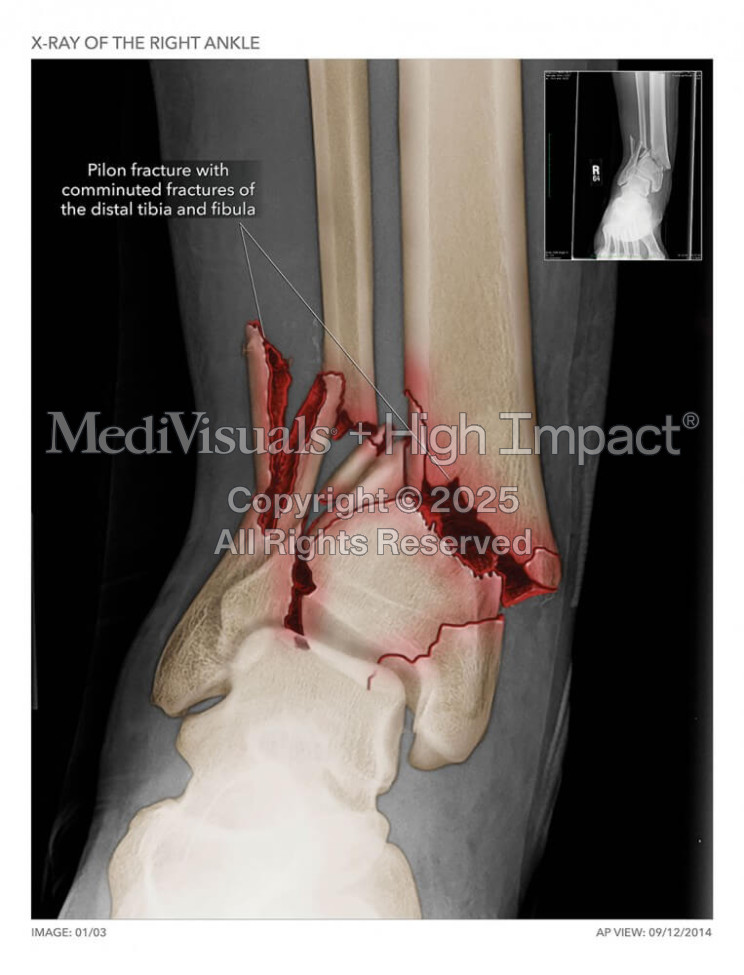 Right Ankle Fracture