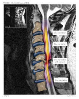 Cervical Herniated Disc MRI