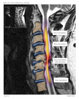 Cervical Herniated Disc MRI
