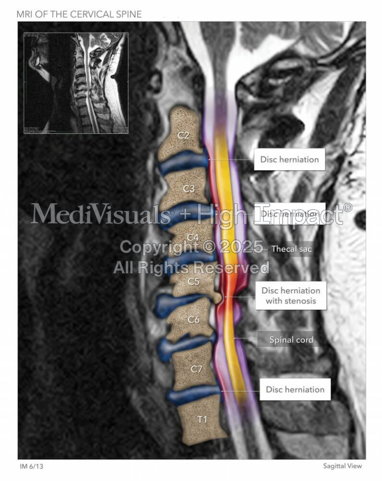 Cervical Herniated Disc MRI