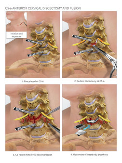 C5-6 Anterior Cervical Discectomy