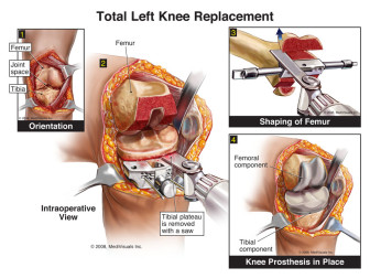 Total Left Knee Replacement