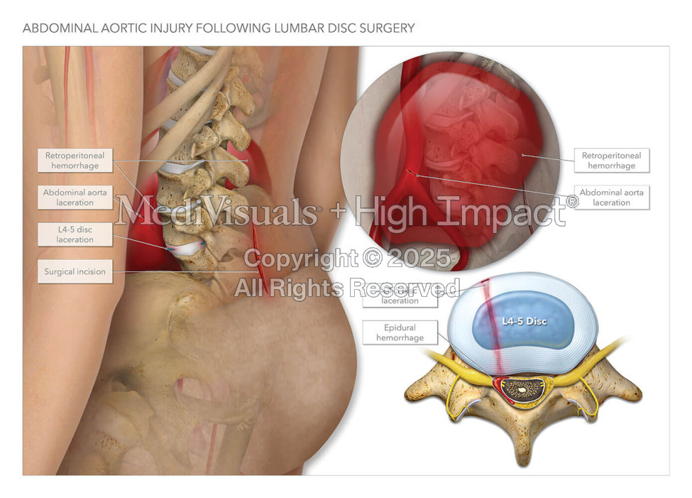 Abdominal Aortic Injury Following Lumbar Disc Surgery