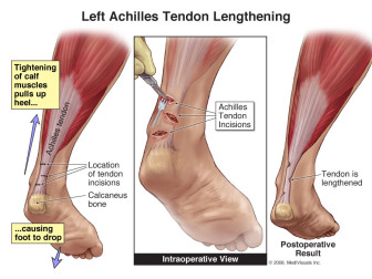 Left Achilles Tendon Lengthening