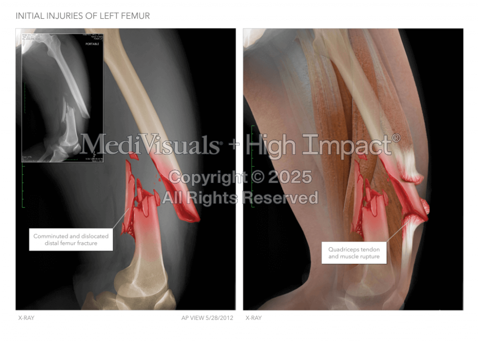 Femur Fracture Illustration