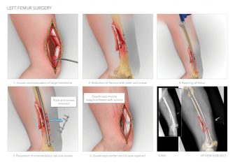 Left Femur Intramedullary Nailing