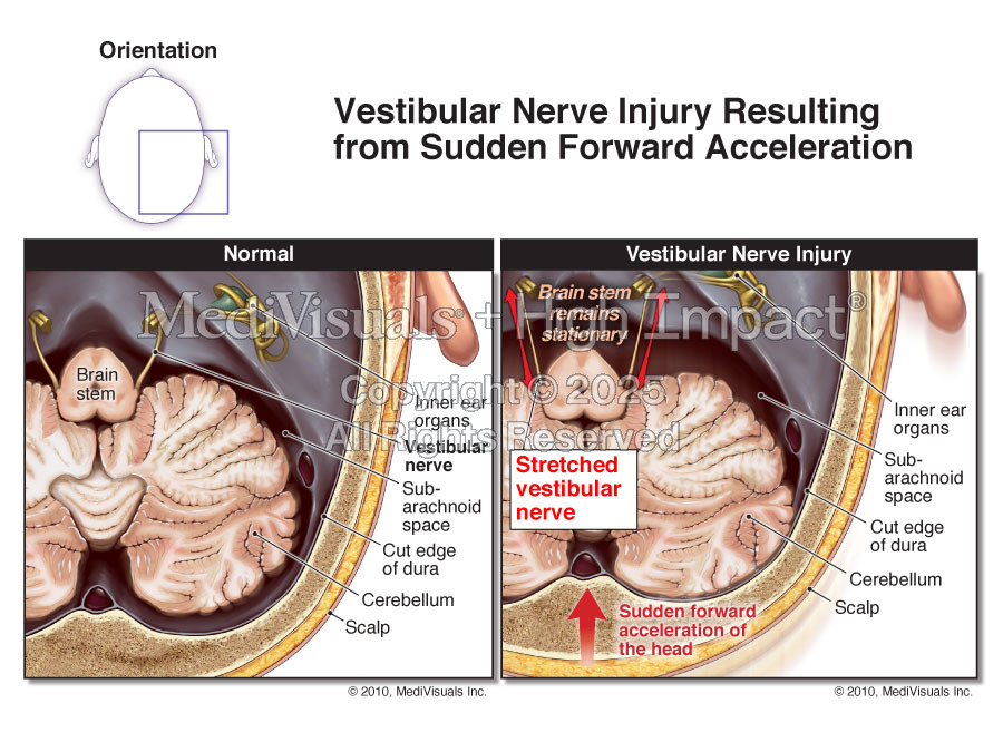 Vestibular Nerve Injury Resulting from Sudden Forward Acceleration