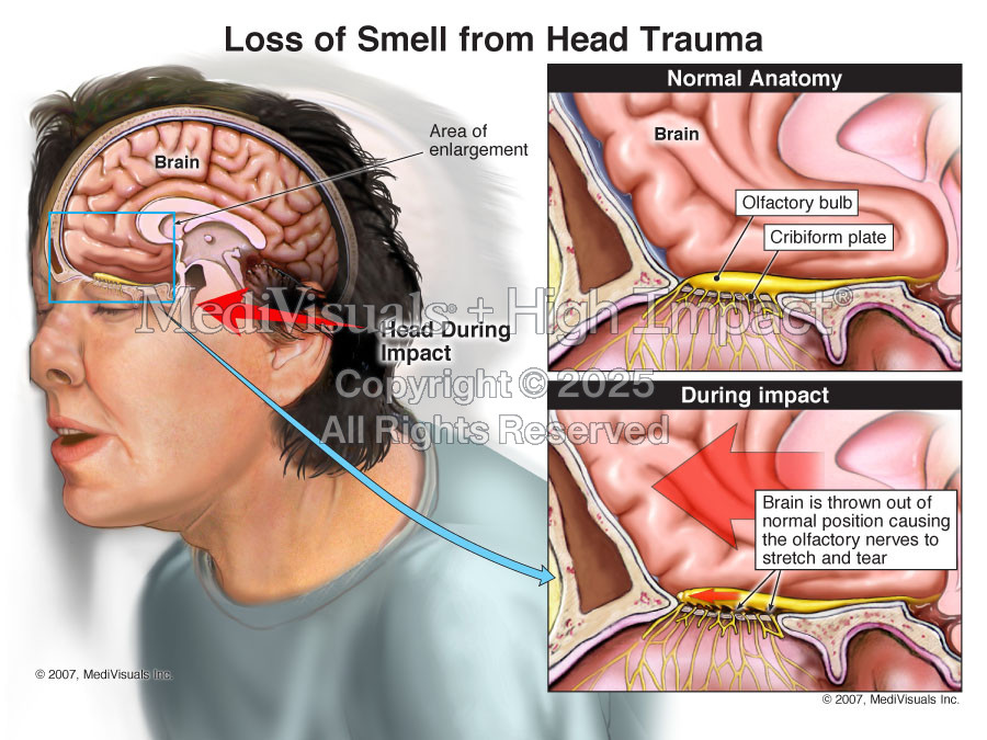 Loss of Smell from Head Trauma