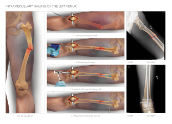 Intramedullary Nailing of Femur
