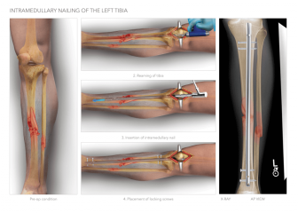 Intramedullary Nailing of Tibia
