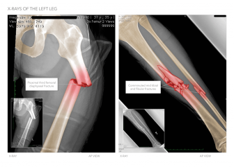 Multiple Leg Fractures
