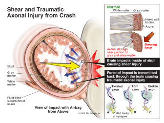 Shear and Traumatic Axonal Injury from Crash