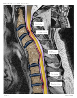 Cervical Disc Bulge