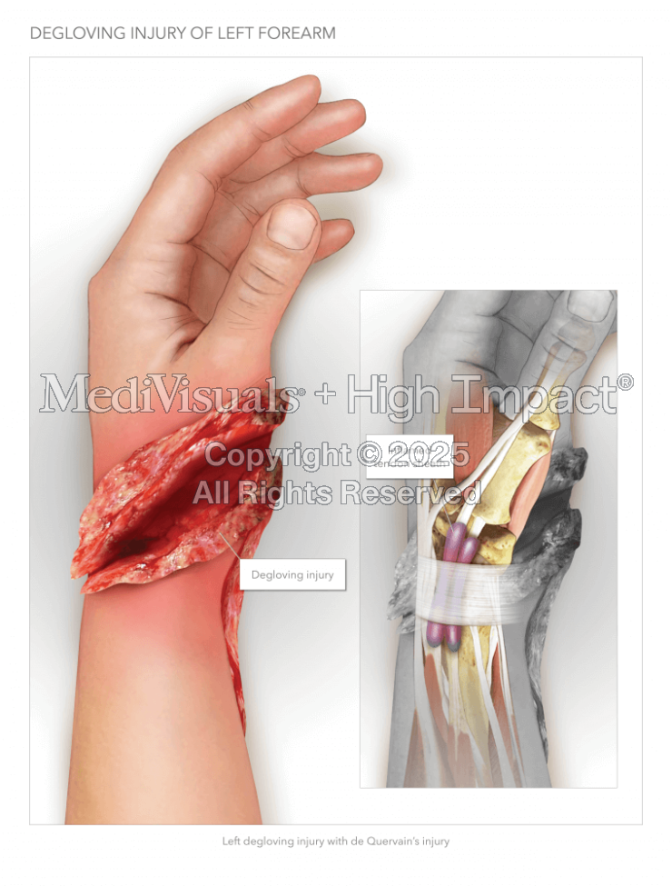 Forearm Degloving Injury