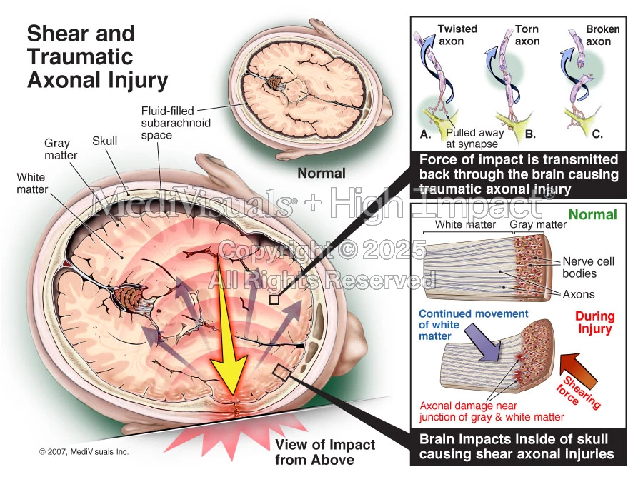 Shear and Traumatic Axonal Injury