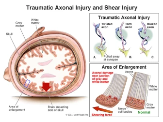 Shear and Traumatic Axonal Injury from Crash