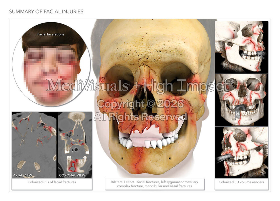 Summary of Facial Fractures and Repair