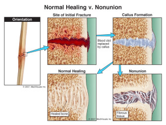 Normal Healing v. Nonunion