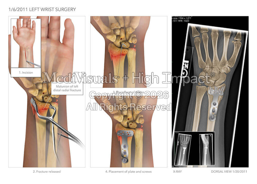 Fractured Wrist Surgery