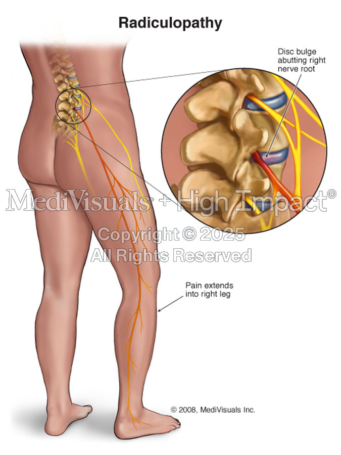 Radiculopathy