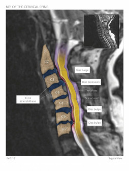 MRI of the Cervical Spine