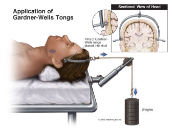 Application of Gardner-Wells Tongs