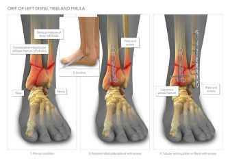 ORIF of Tibia and Fibula