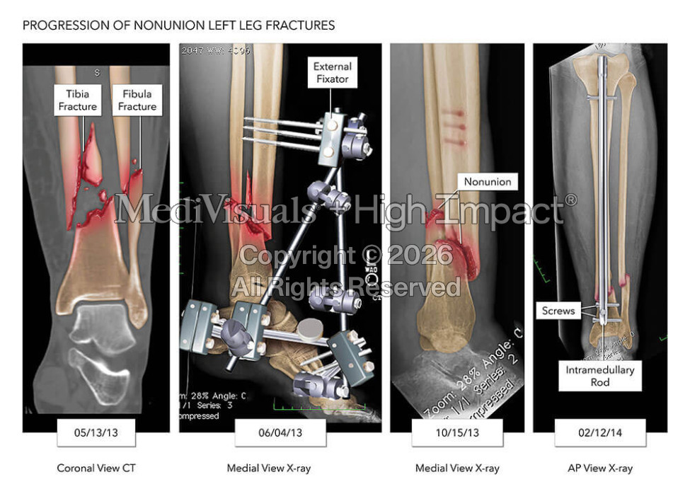 Failed Fixation of Fractures