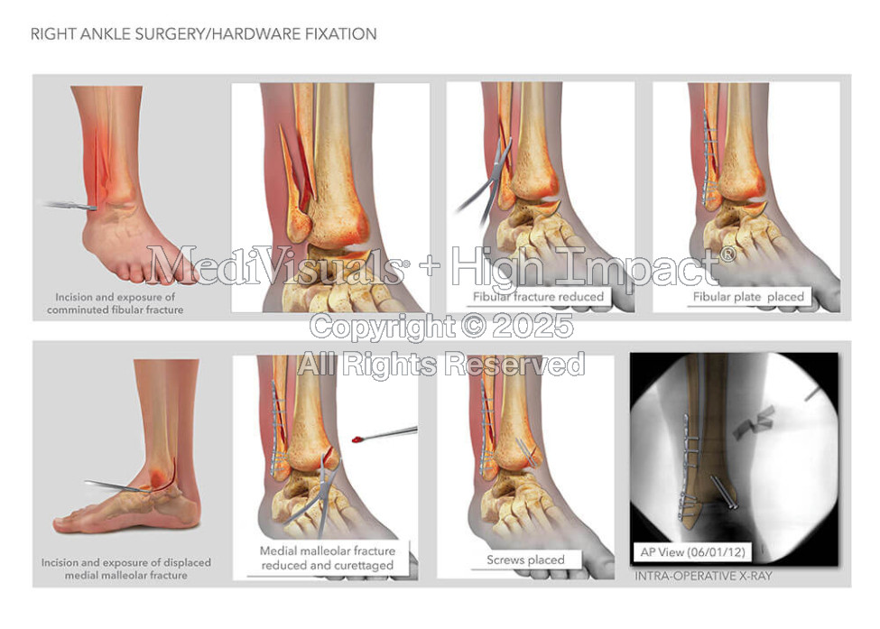 Right Ankle Surgery/Hardware Fixation
