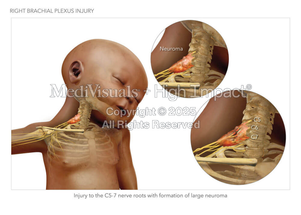Infant Brachial Plexus Injury