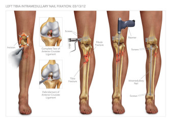 Tibia Intramedullary Nail Fixation