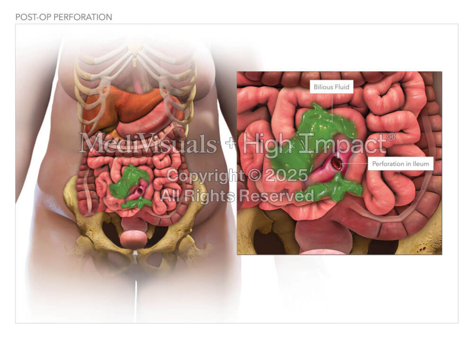 Small Intestine Perforation
