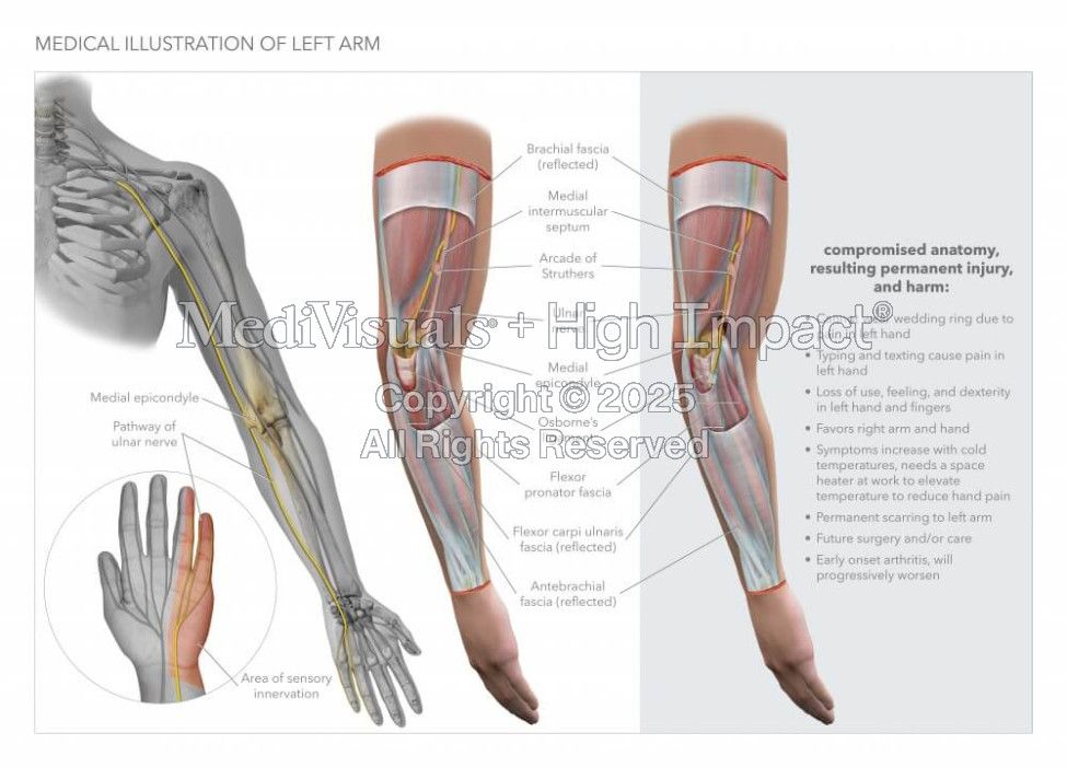 Medical Illustration of Left Arm