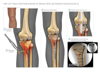 Tibia ORIF and Tendon Repair